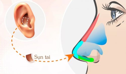 nang_mui_sun_tai_la_gi_giai_dap_thac_mac_ve_nang_mui_bang_sun_tai_1_153eb9739c.jpg